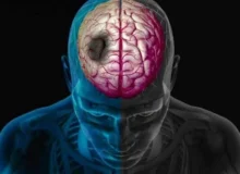 یک متخصص: هر دقیقه تأخیر در درمان سکته مغزی به نابودی ۱.۹ میلیون سلول عصبی منجر میشود